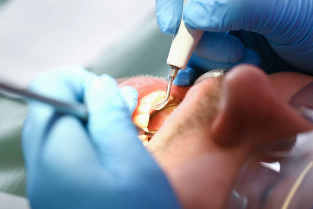 Best Emergency Root Canal Treatment in Mar Mac, NC